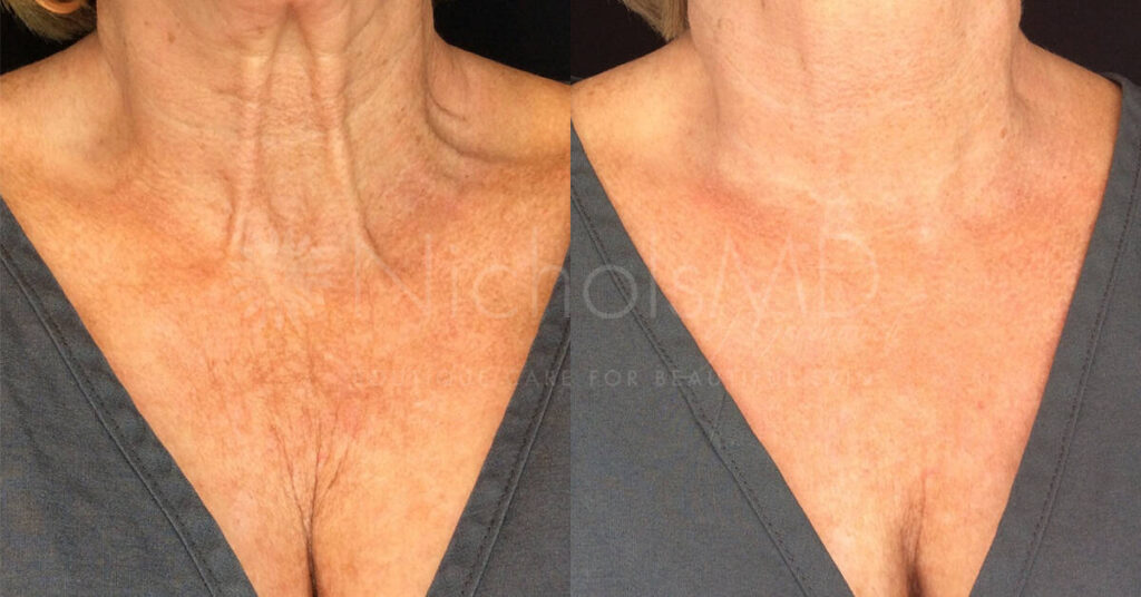 Laser Treatments NicholsMD of Greenwich