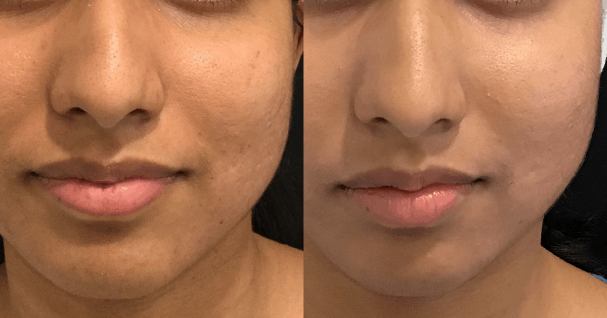 NicholsMD Fraxel Before and After
