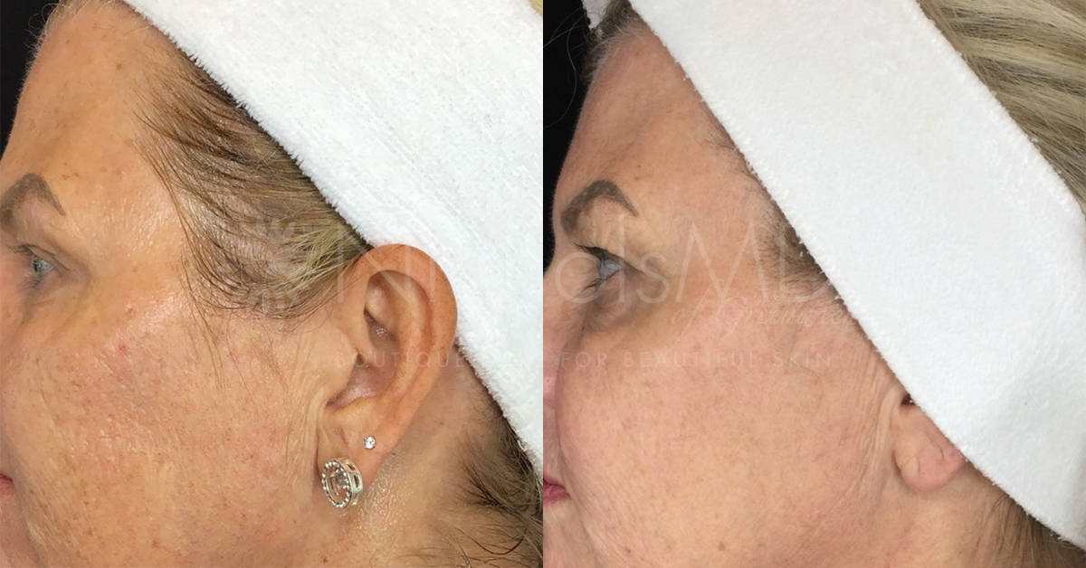 NicholsMD Fraxel Before and After