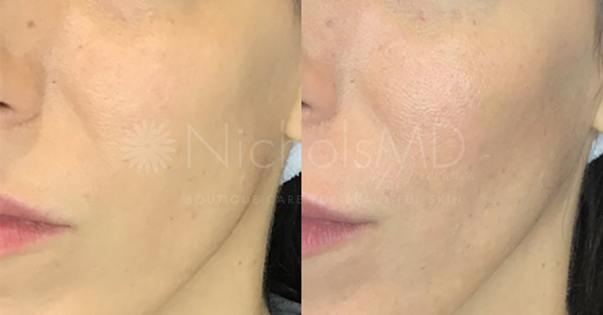 Dr. Nichols' Liquid Cheek Pop
