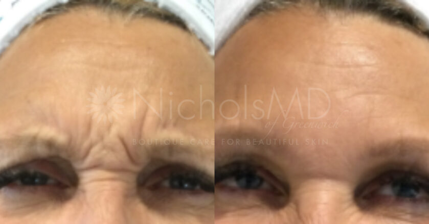 NMD- Botox® Upper Face Treatment