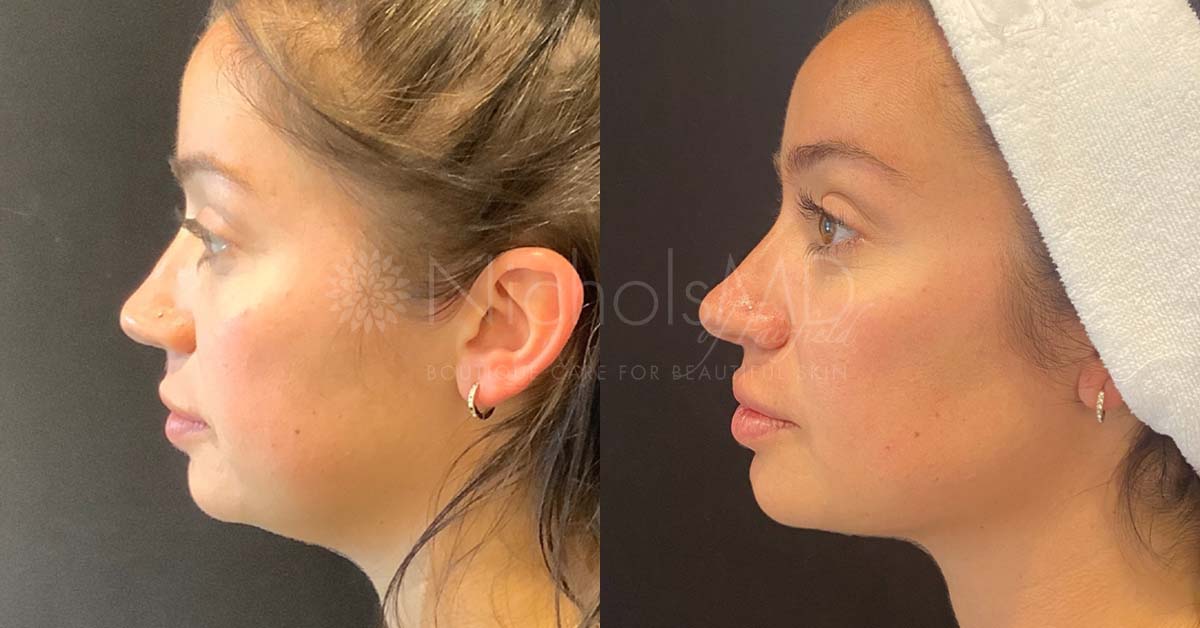 NicholsMd of Fairfield Jawline Contour Treatment