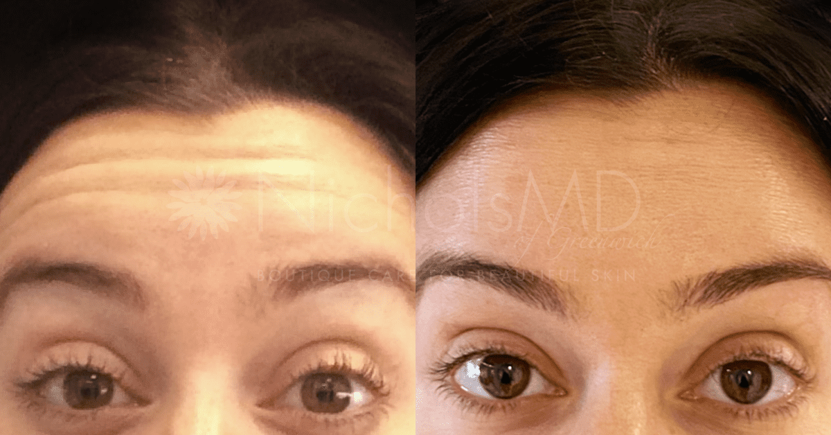 NicholsMD of Greenwich Botox Treatment