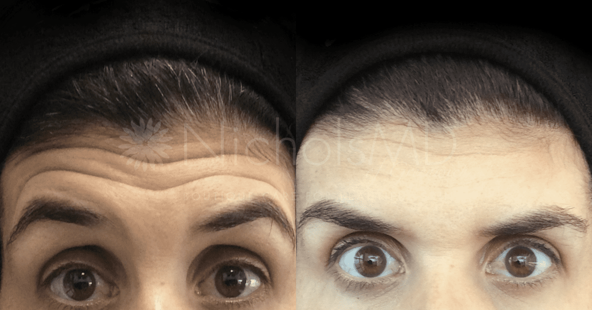 NicholsMD of Greenwich Botox Treatment