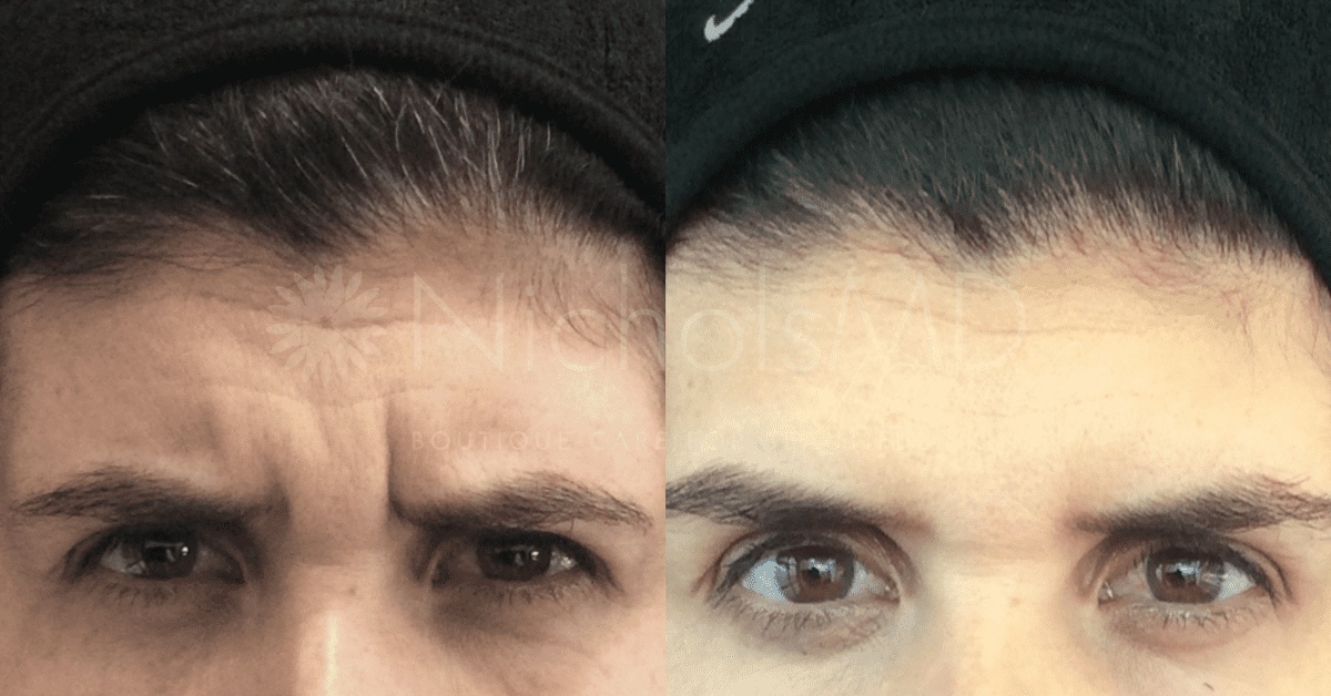 NicholsMD of Greenwich Botox Treatment