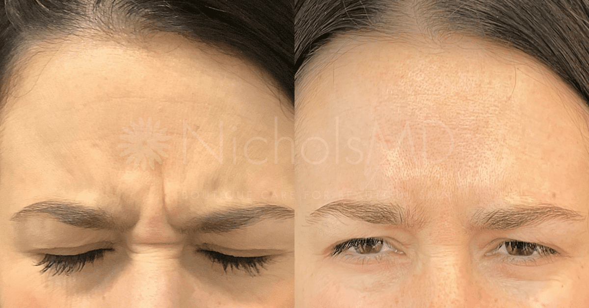 NicholsMD of Greenwich Botox Treatment