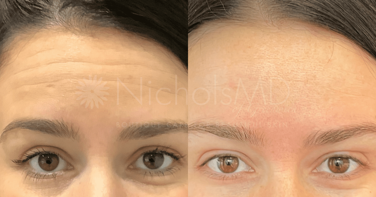 NicholsMD of Greenwich Botox Treatment