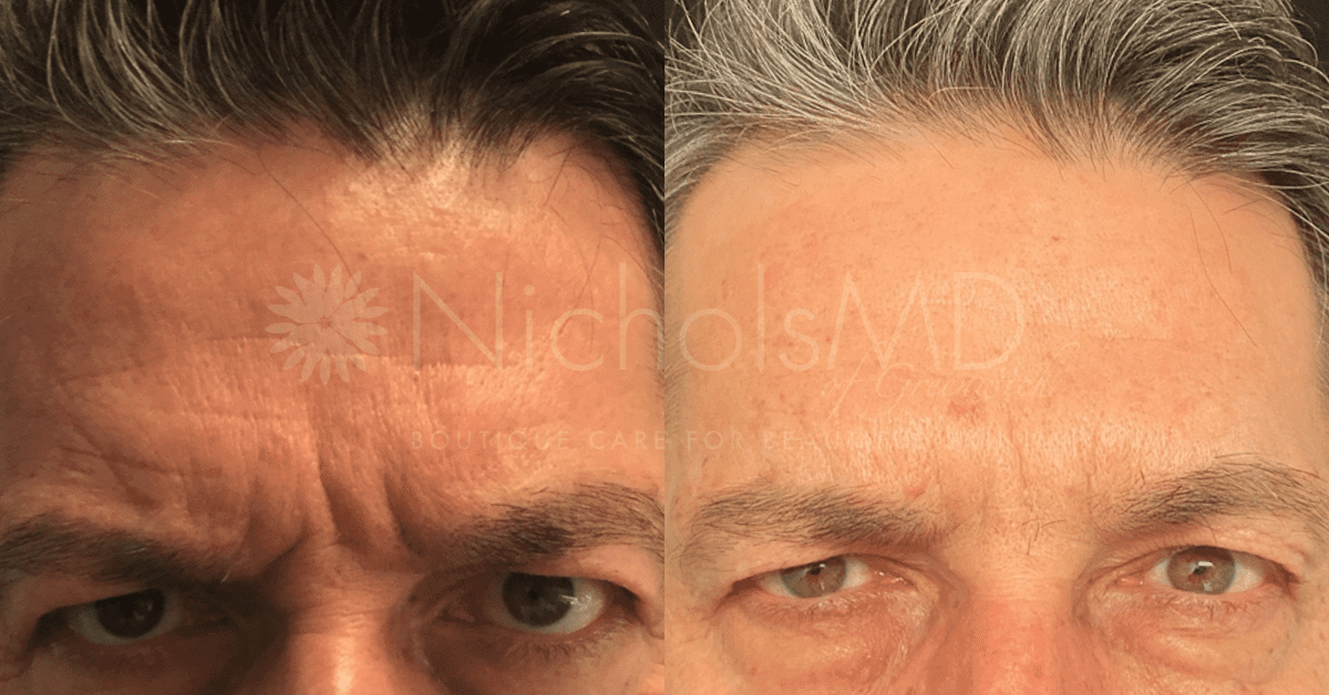 NicholsMD of Greenwich Botox Treatment