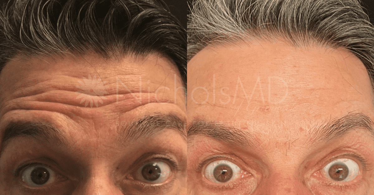 NicholsMD of Greenwich Botox Treatment