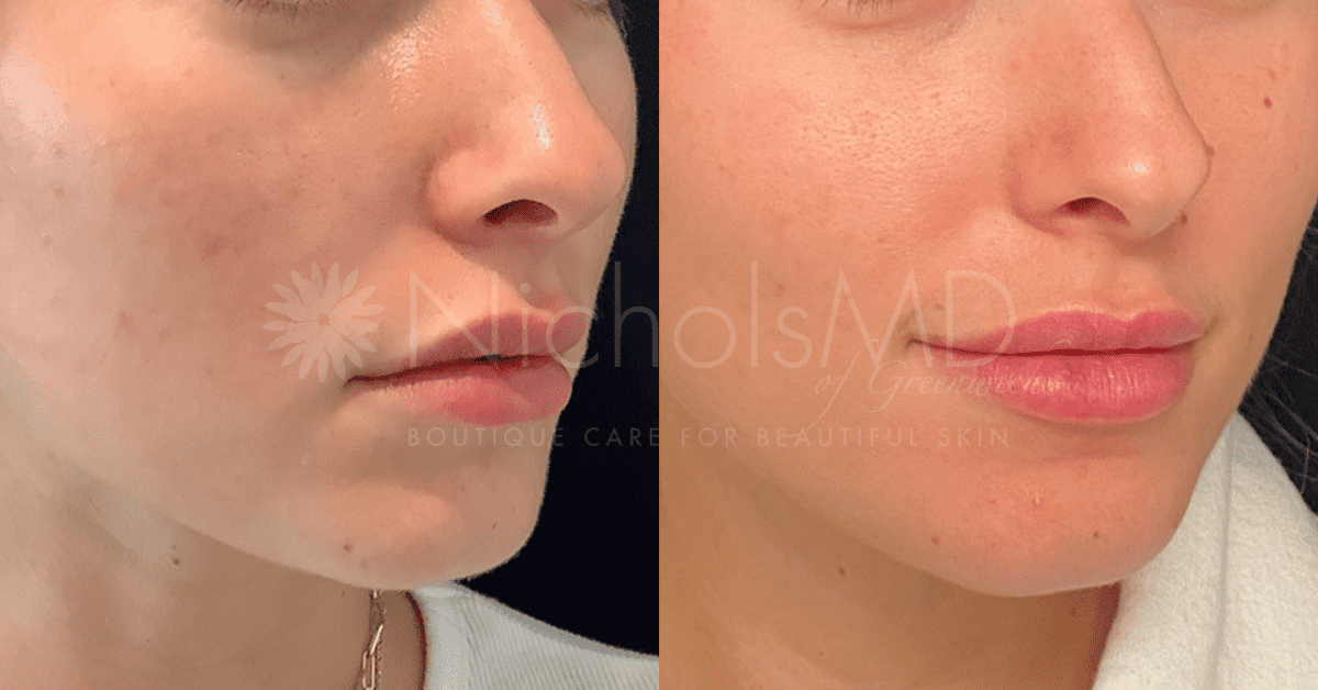 NicholsMD of Greenwich PRP Microneedling Treatment