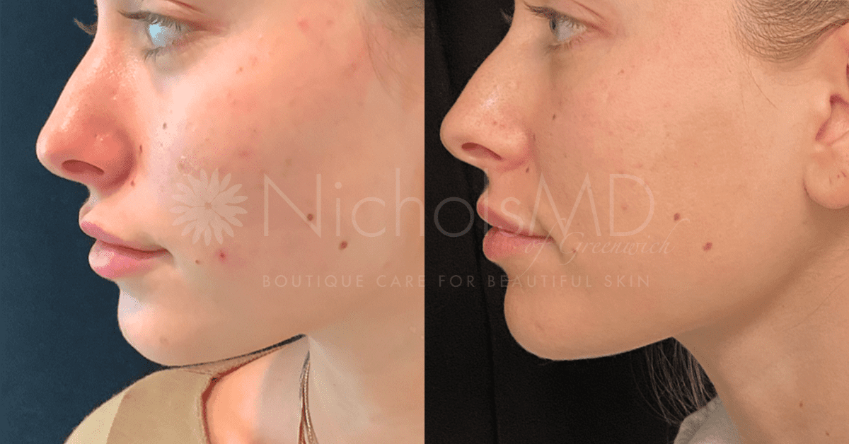 NicholsMD of Greenwich PRP Microneedling Treatment