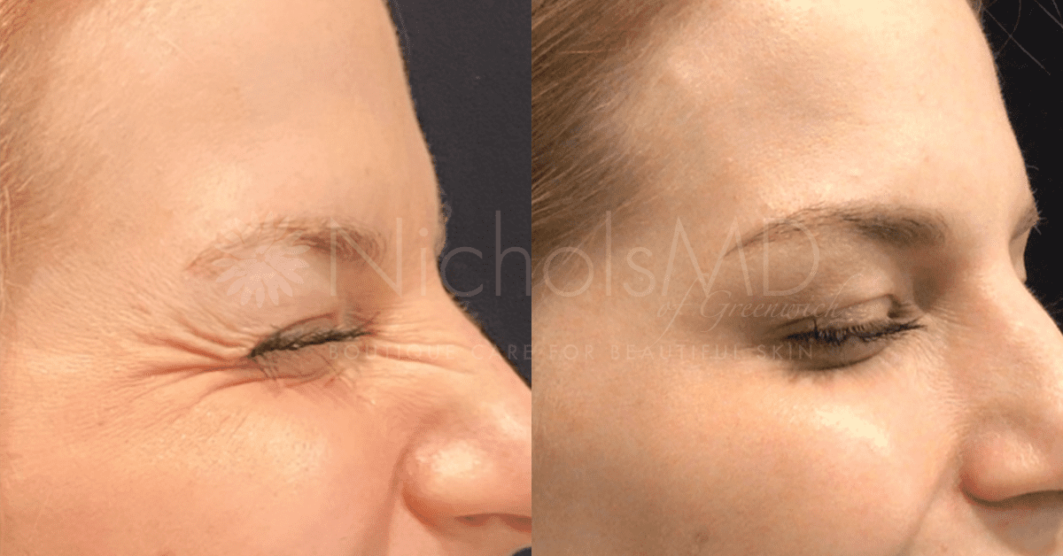 NicholsMD of Greenwich Dysport Treatment