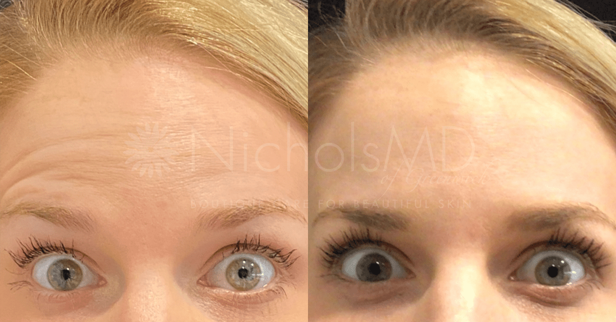 NicholsMD of Greenwich Dysport Treatment