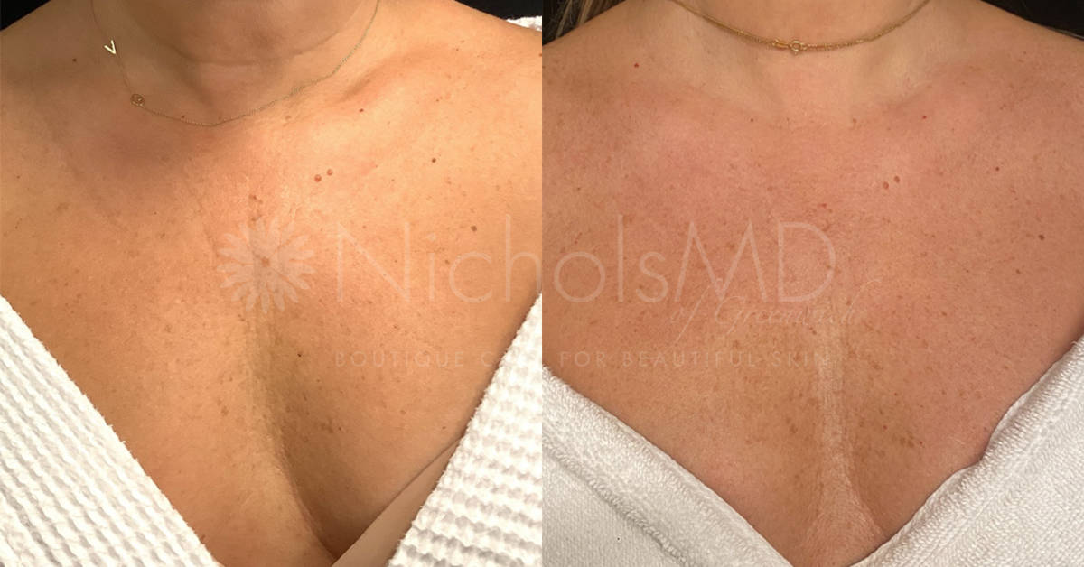 NicholsMD of Greenwich Mini Tox Treatment