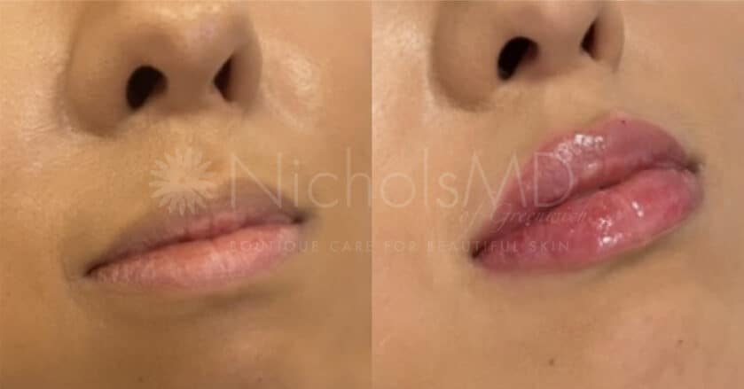 NicholsMD of Greenwich Liquid Lip Lift Treatment