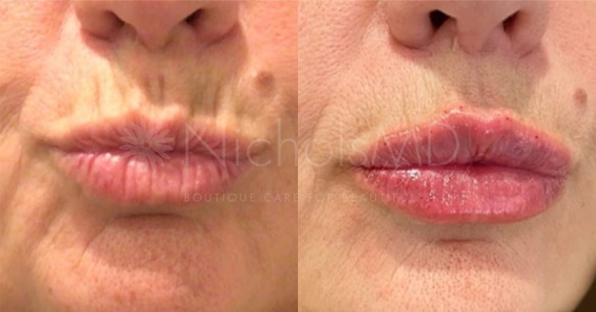NicholsMD of Greenwich Liquid Lip Lift Treatment