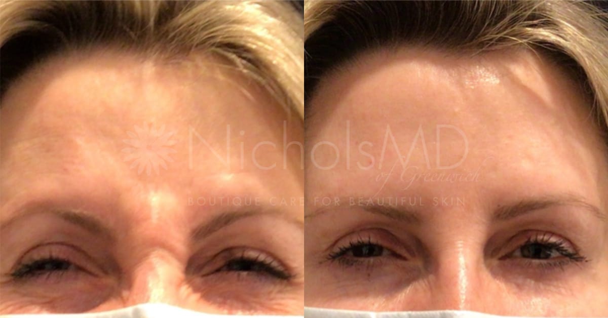 NicholsMD of Greenwich Botox® Treatment