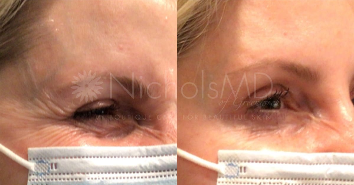 NicholsMD of Greenwich Botox® Treatment