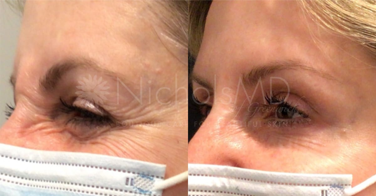 NicholsMD of Greenwich Botox® Treatment
