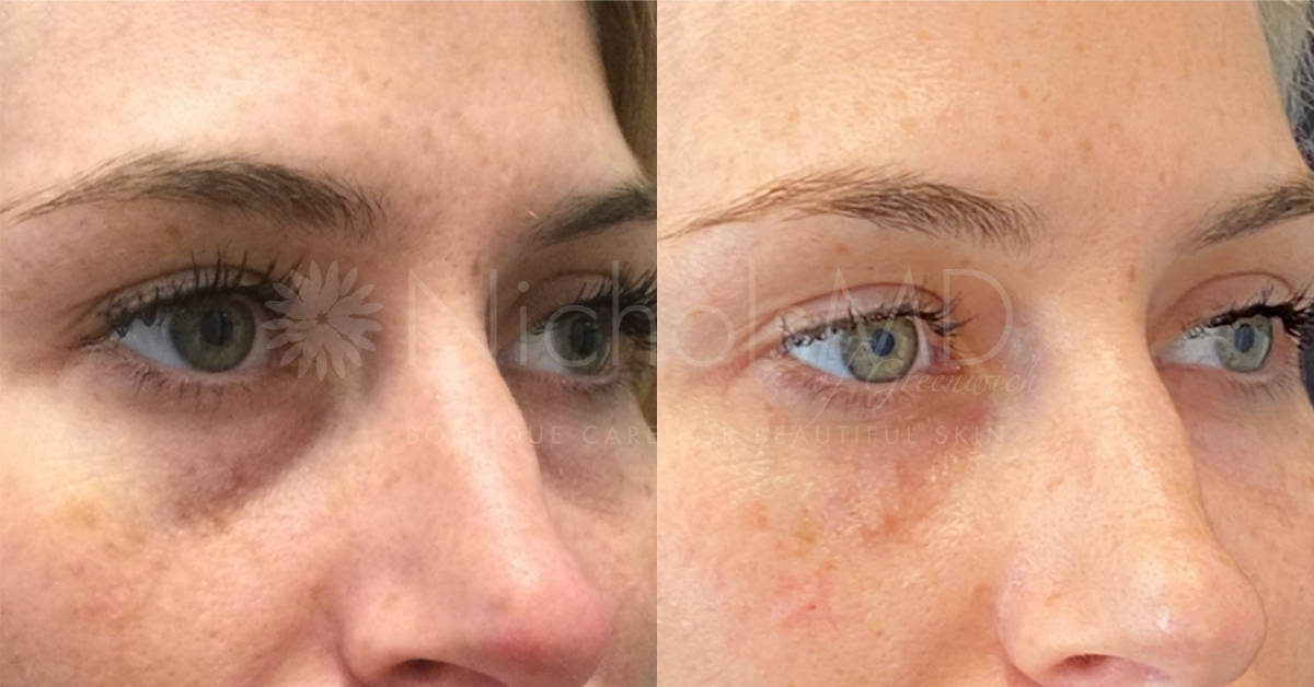 NicholsMD of Greenwich Undereye Rejuvenation Treatment