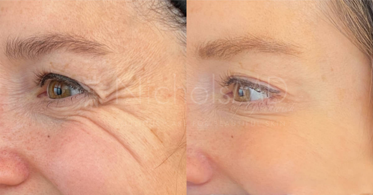 NicholsMD of Greenwich Botox® Treatment