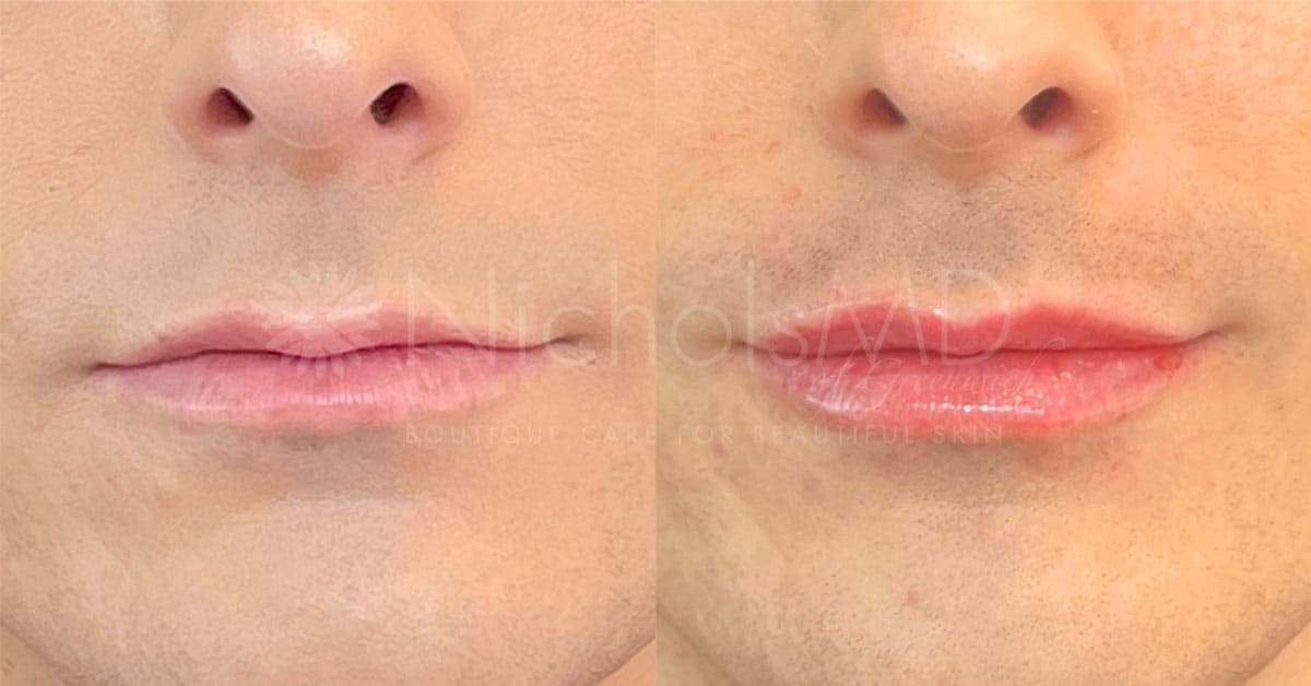 NicholsMD of Greenwich Liquid Lip Lift Treatment
