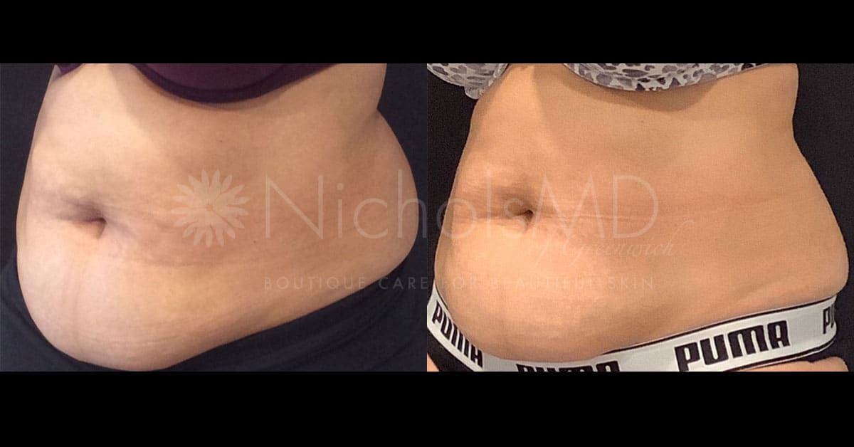 NicholsMD of Greenwich Coolsculpt Treatment
