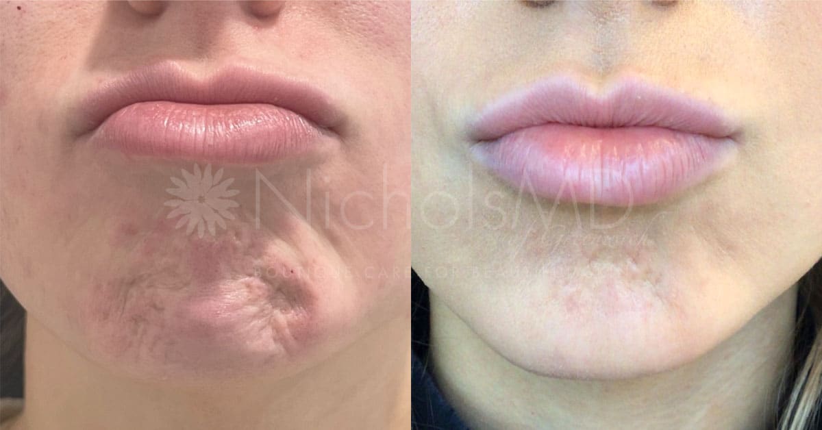 NicholsMD of Greenwich Chin Relaxer Treatment