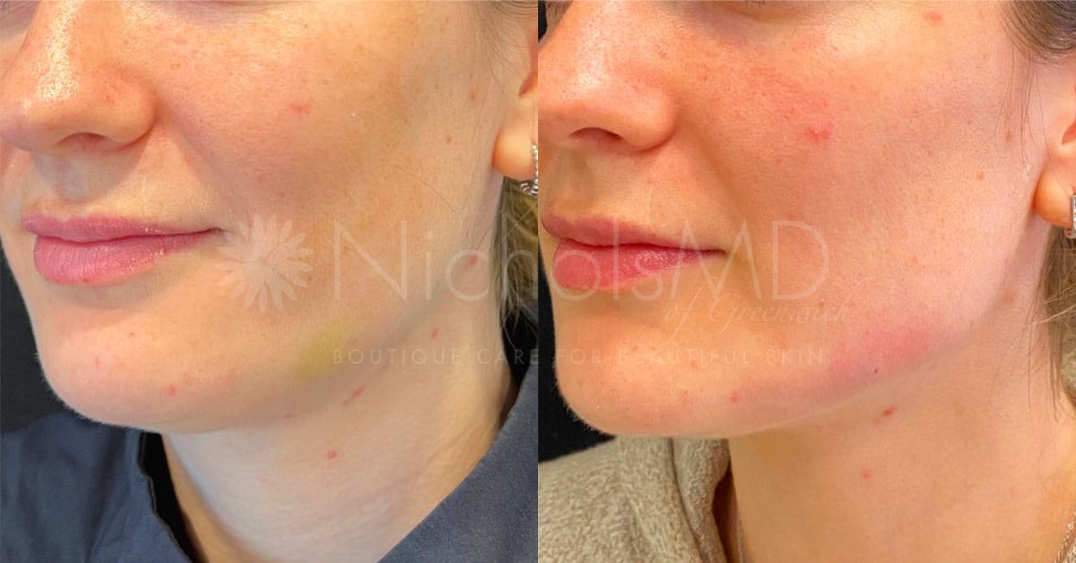 NicholsMD of Greenwich Jawline Contour Treatment