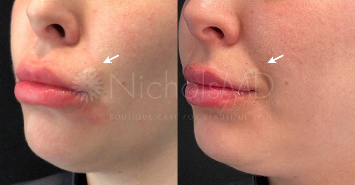 NicholsMD of Greenwich Lip Rescue Treatment