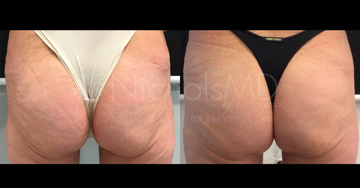 NicholsMD of Greenwich Jawline Sculptra Treatment