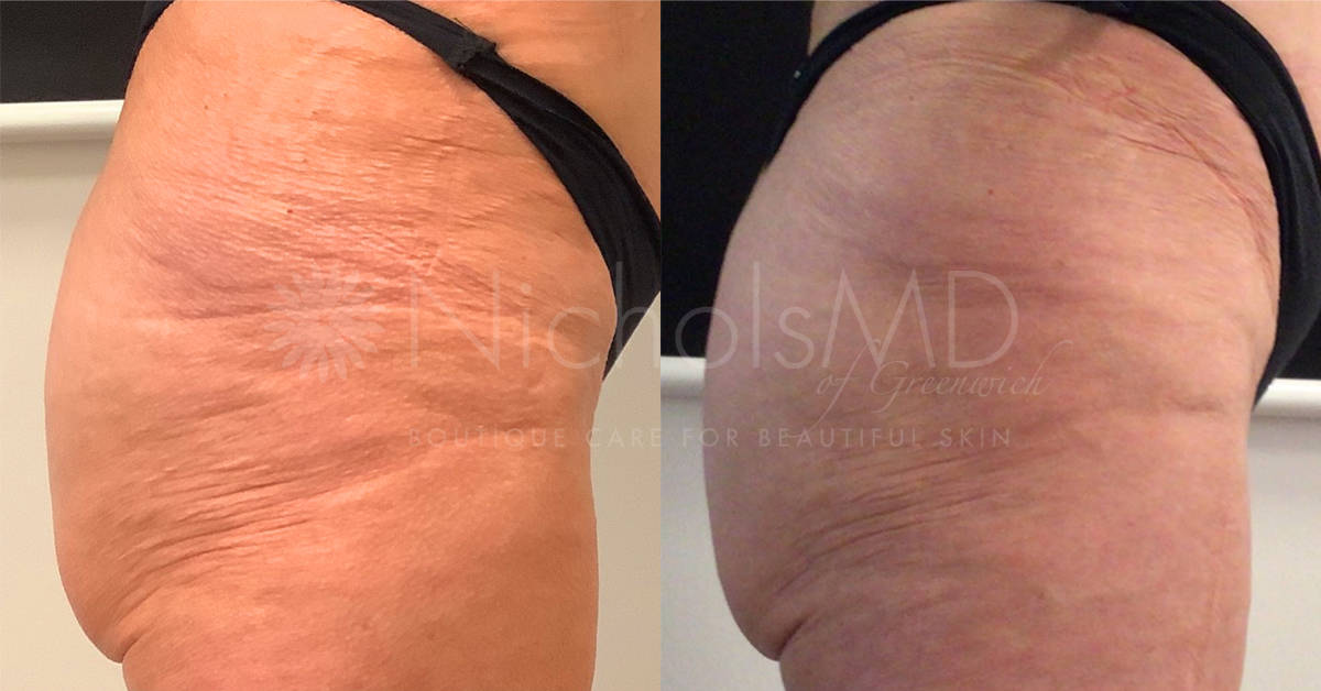 NicholsMD of Greenwich Jawline Sculptra Treatment