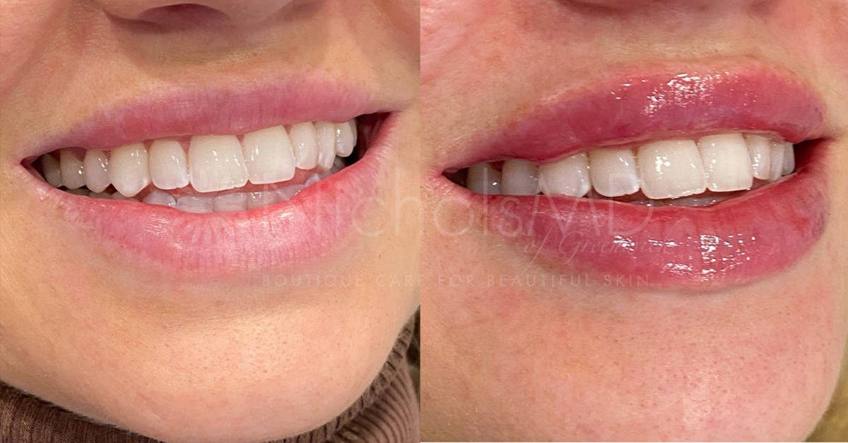 NicholsMD of Greenwich Liquid Lip Lift Treatment