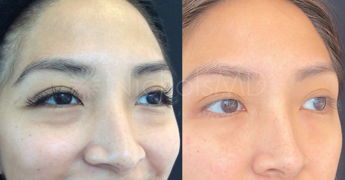 NicholsMD of Greenwich PRP Undereye Treatment
