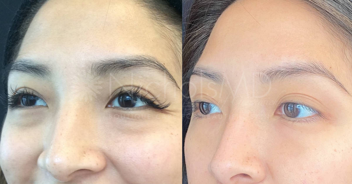 NicholsMD of Greenwich PRP Undereye Treatment