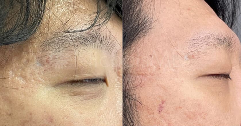 NicholsMD of Greenwich Fraxel Laser for Acne Scars Treatment