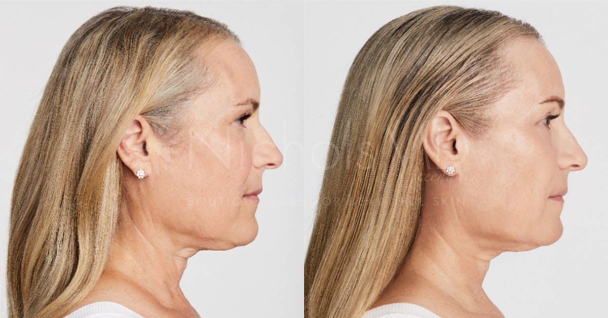 NicholsMD of Greenwich Ultherapy Treatment