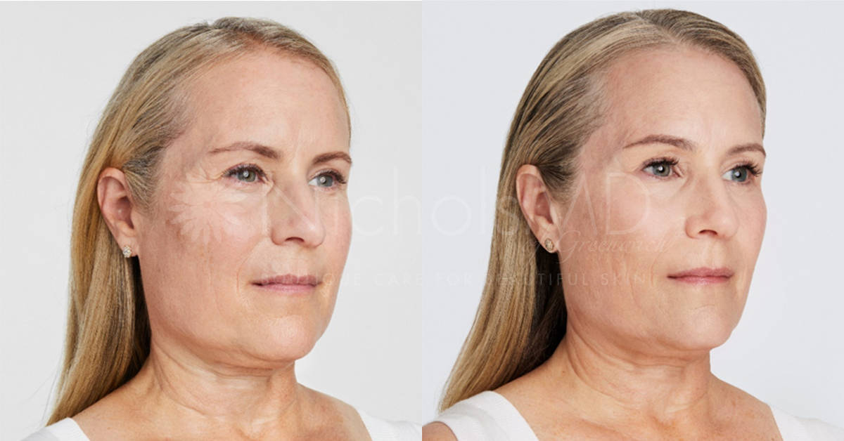 NicholsMD of Greenwich Ultherapy Treatment