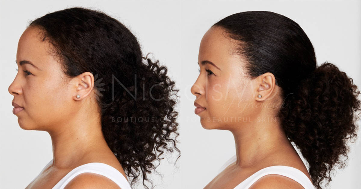 NicholsMD of Greenwich Ultherapy Treatment