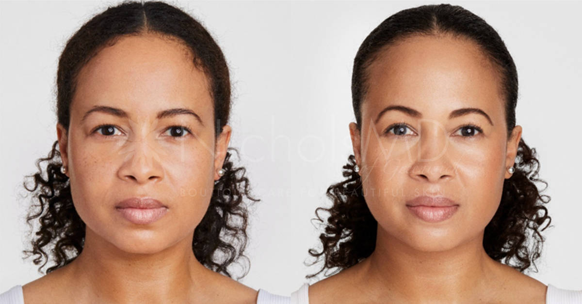 NicholsMD of Greenwich Ultherapy Treatment