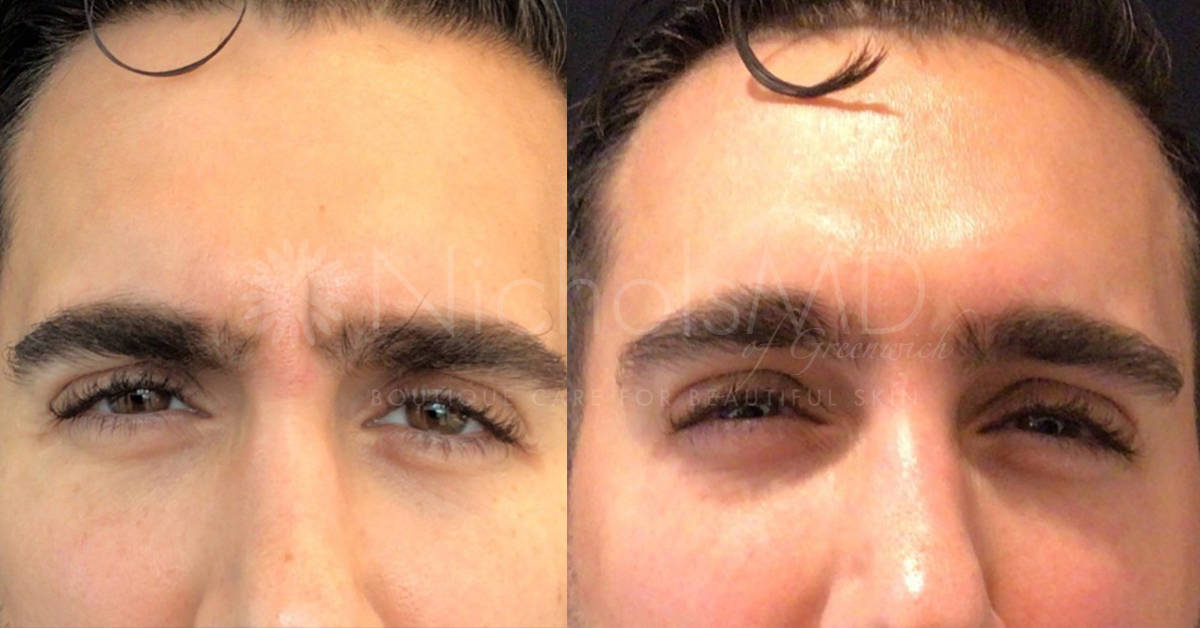 NicholsMD of Greenwich Botox® Treatment