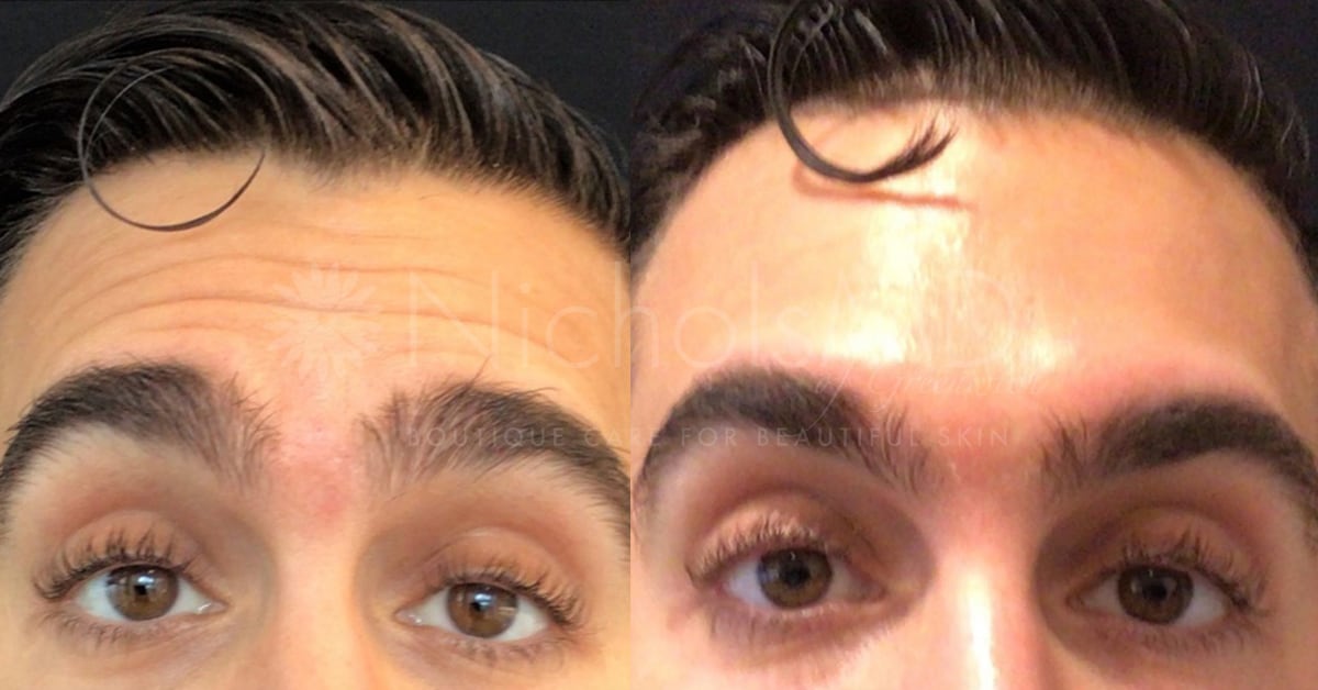 NicholsMD of Greenwich Botox® Treatment