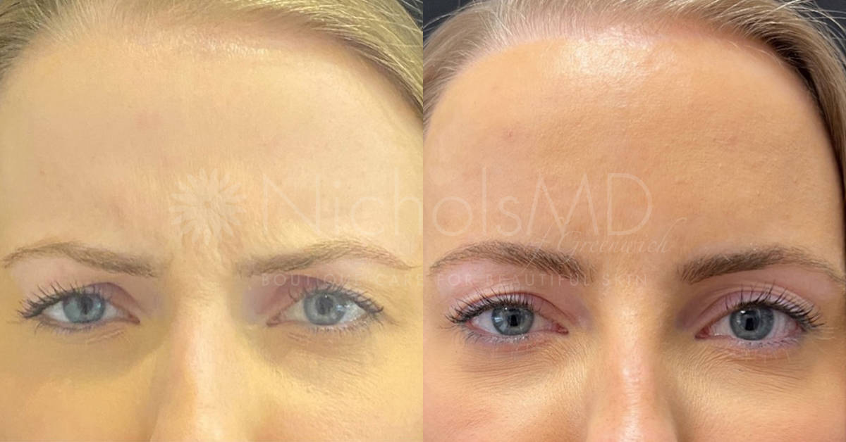 NicholsMD of Greenwich Botox® Treatment
