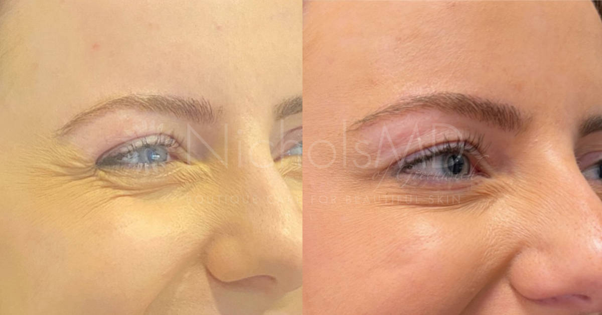 NicholsMD of Greenwich Botox® Treatment