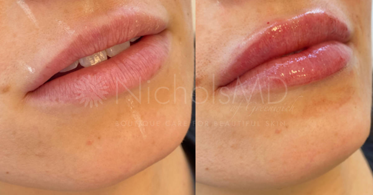 NicholsMD of Greenwich Liquid Lip Lift Treatment