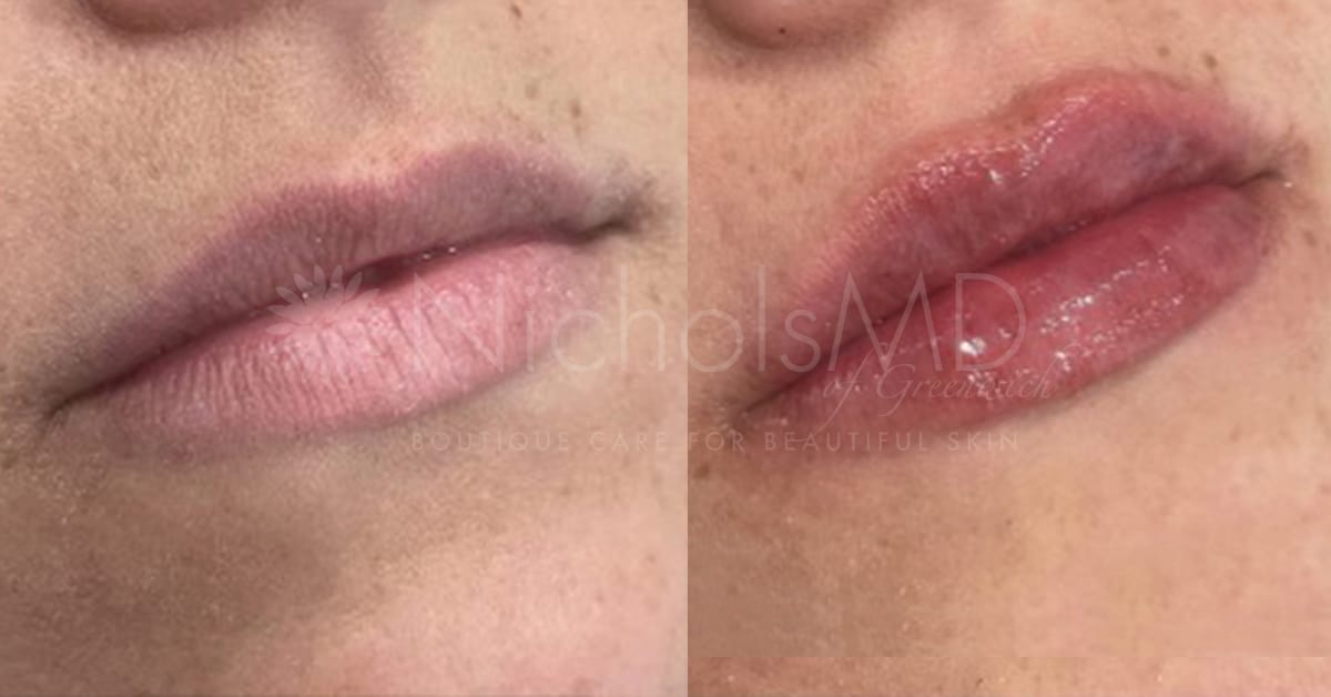 NicholsMD of Greenwich Liquid Lip Lift Treatment