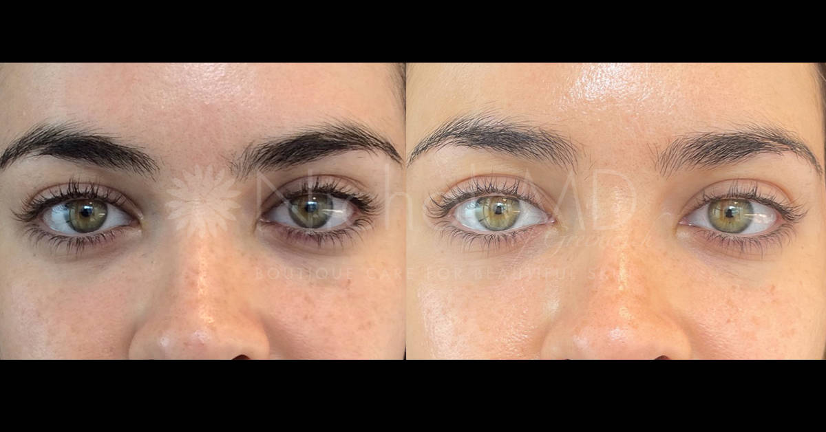 NicholsMD of Greenwich PRP Undereye Treatment