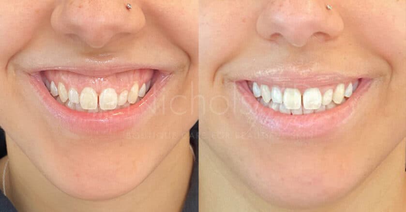 NicholsMD of Greenwich After Botox(R) for Gummy Smile and Lip Flip Treatment