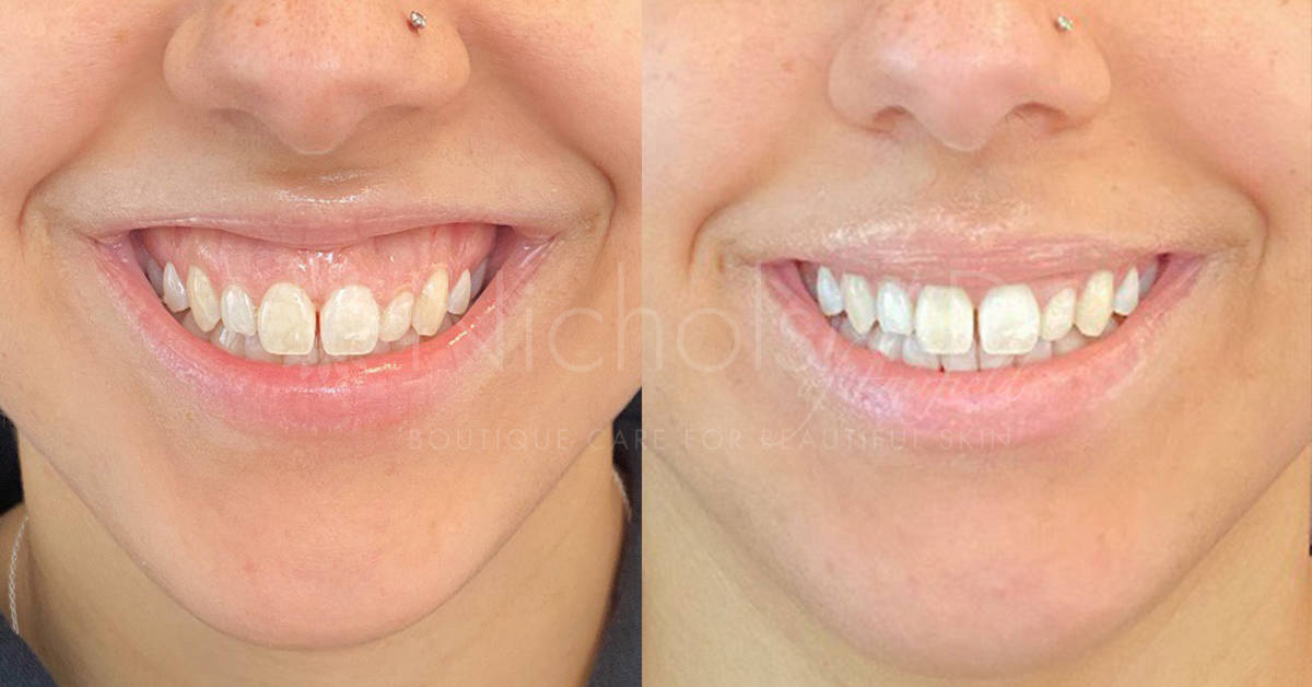 Lip Flip Smile Before And After 398 — Botox(R) for Gummy Smile and Lip Flip - NicholsMD of Greenwich