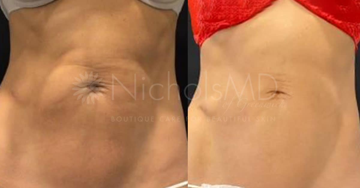 NicholsMD of Greenwich Sculptra Treatment